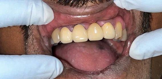 Prosthodontics After