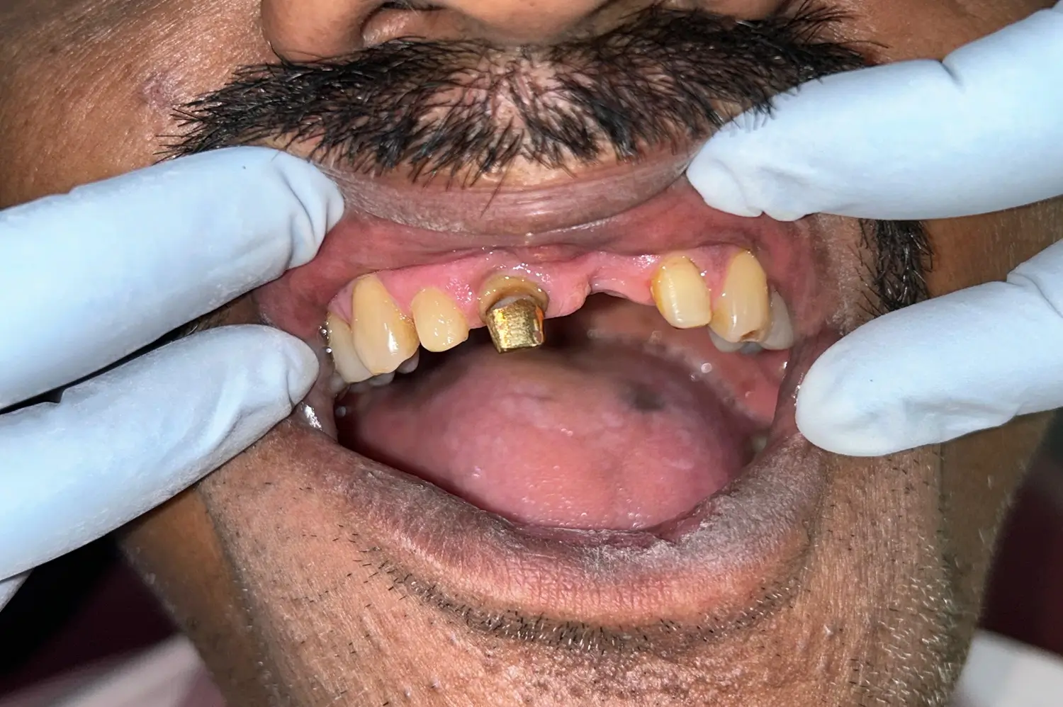 Prosthodontics Before