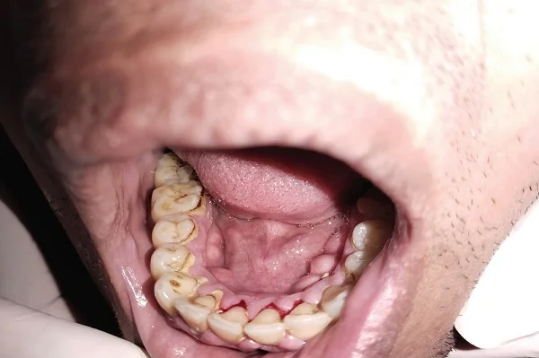 Dental Scaling