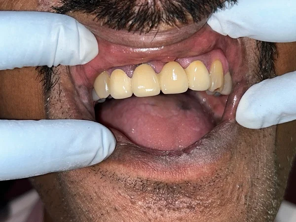 Dental Implant
