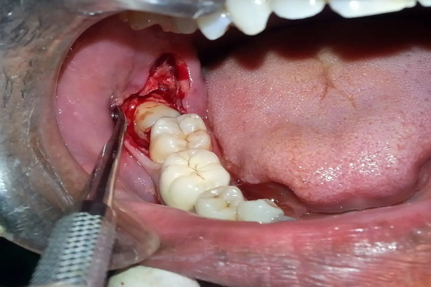 Oral Surgery