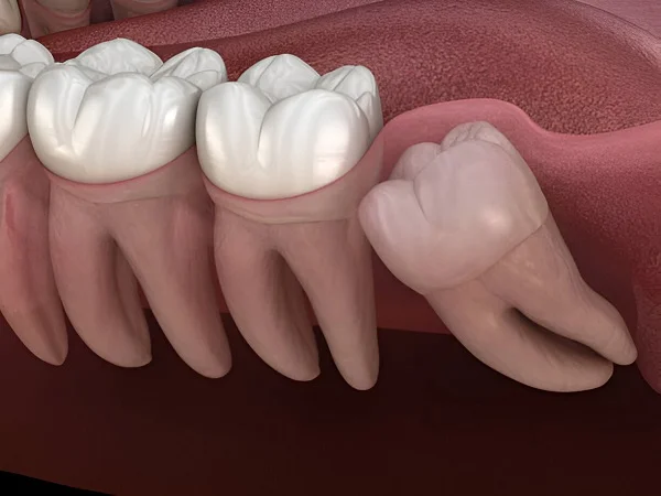 Wisdom Tooth Extraction